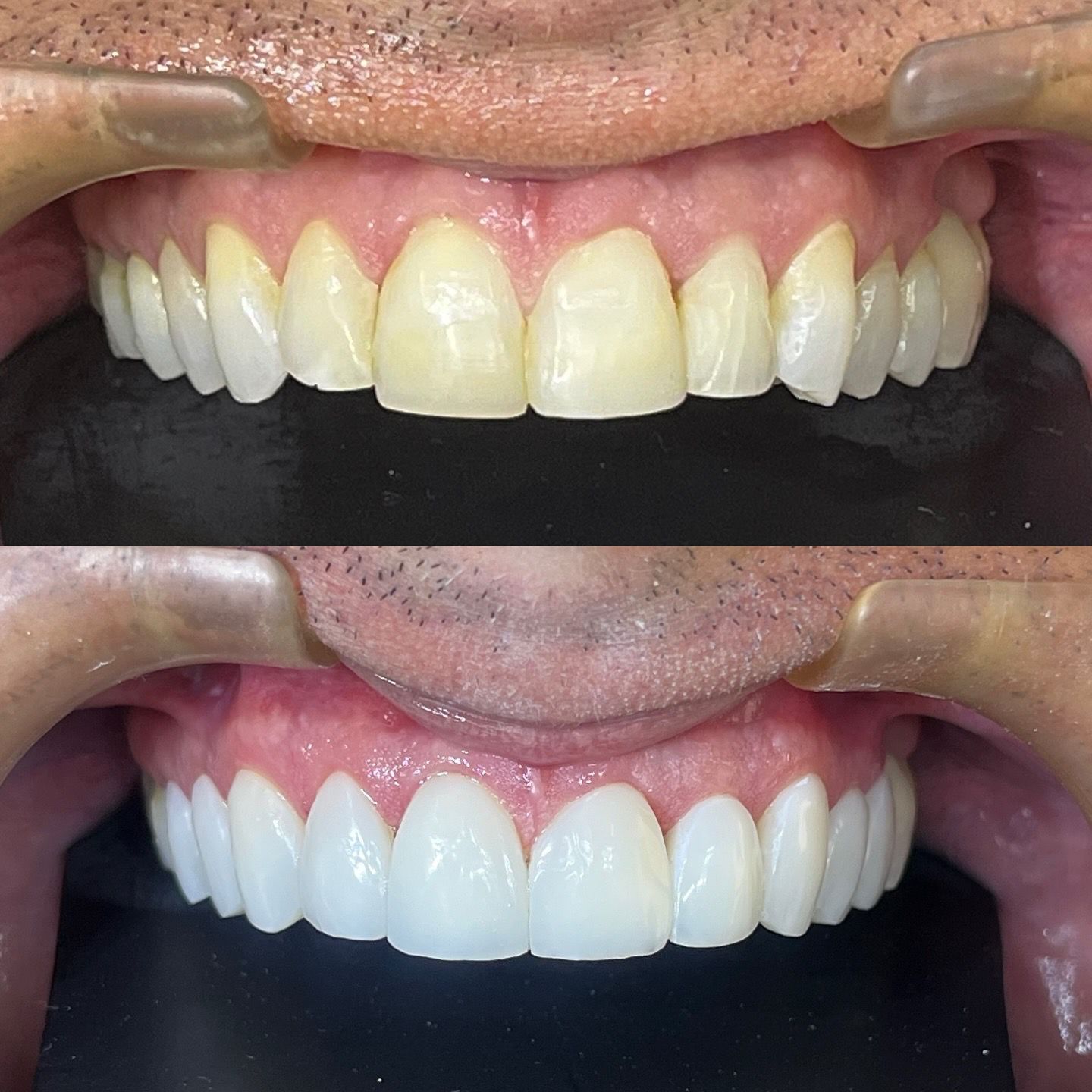 antes-depois-dr-fabio-moura-1