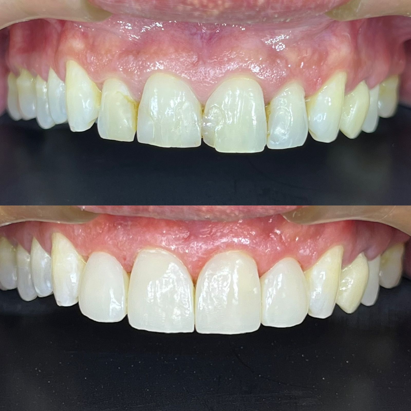 antes-depois-dr-fabio-moura-10
