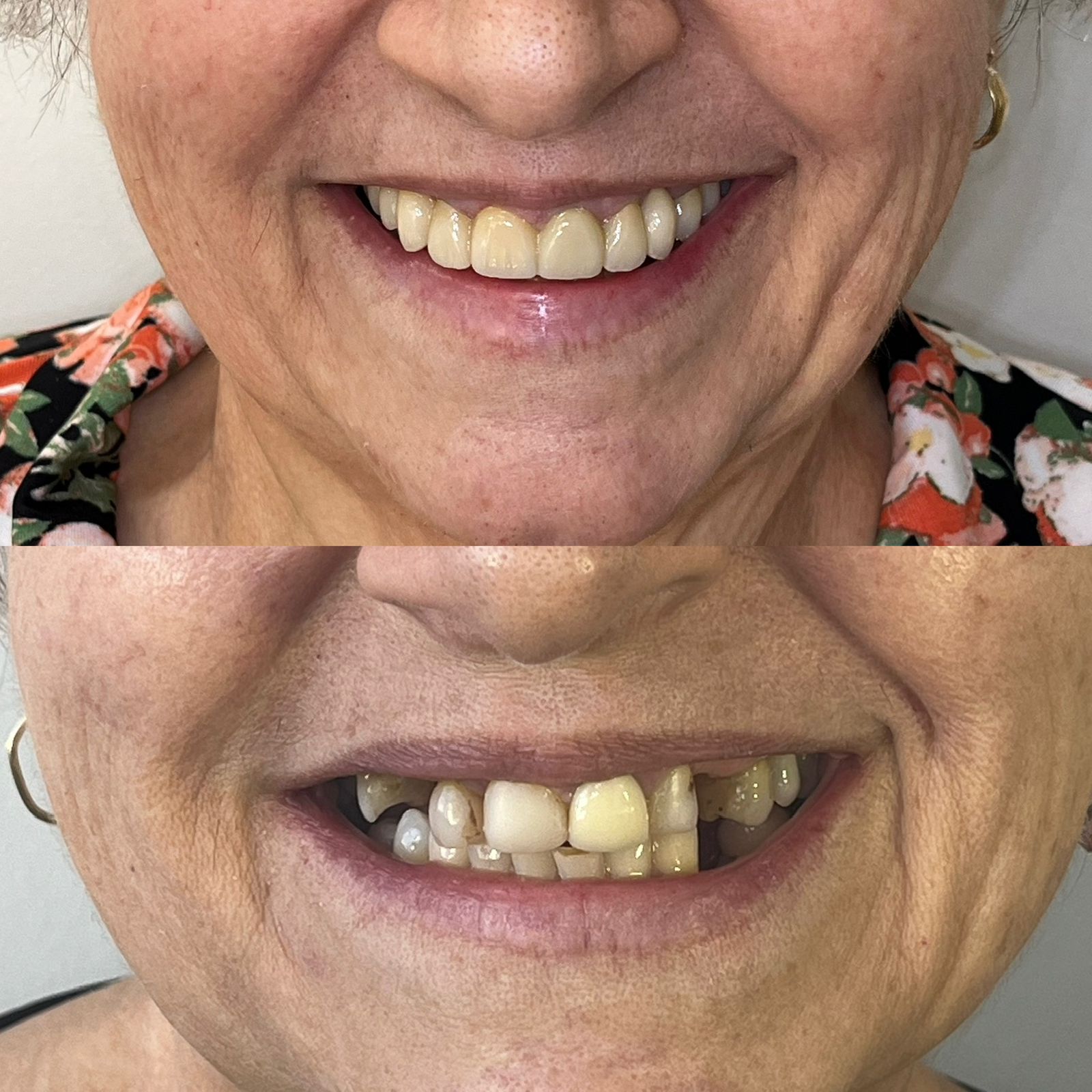 antes-depois-dr-fabio-moura-11