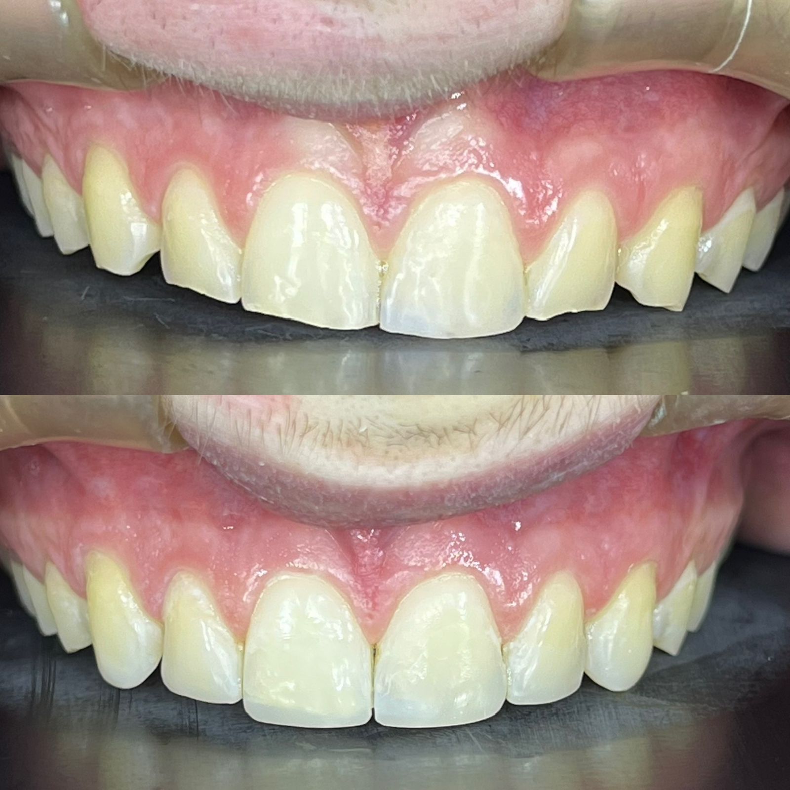 antes-depois-dr-fabio-moura-14