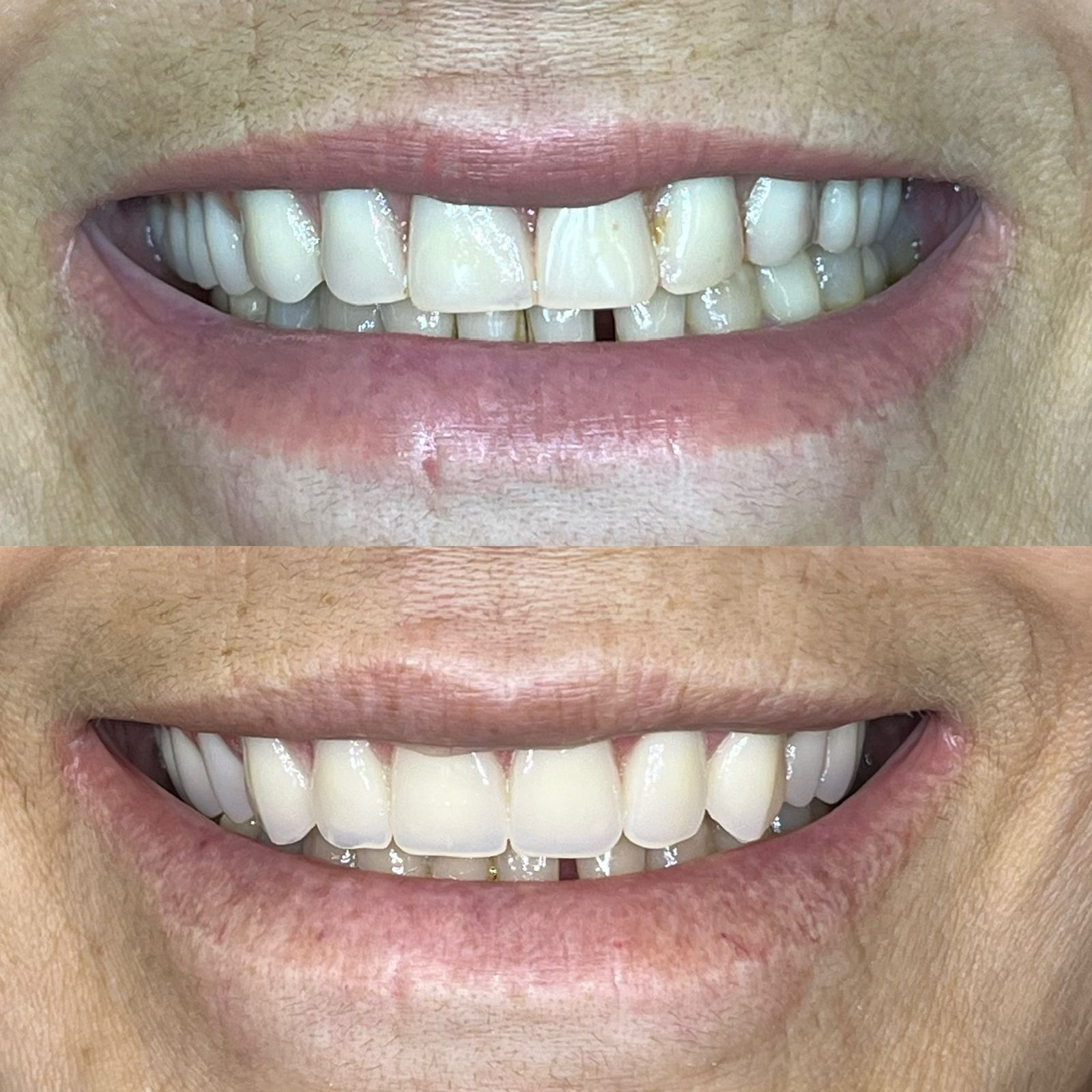 antes-depois-dr-fabio-moura-15