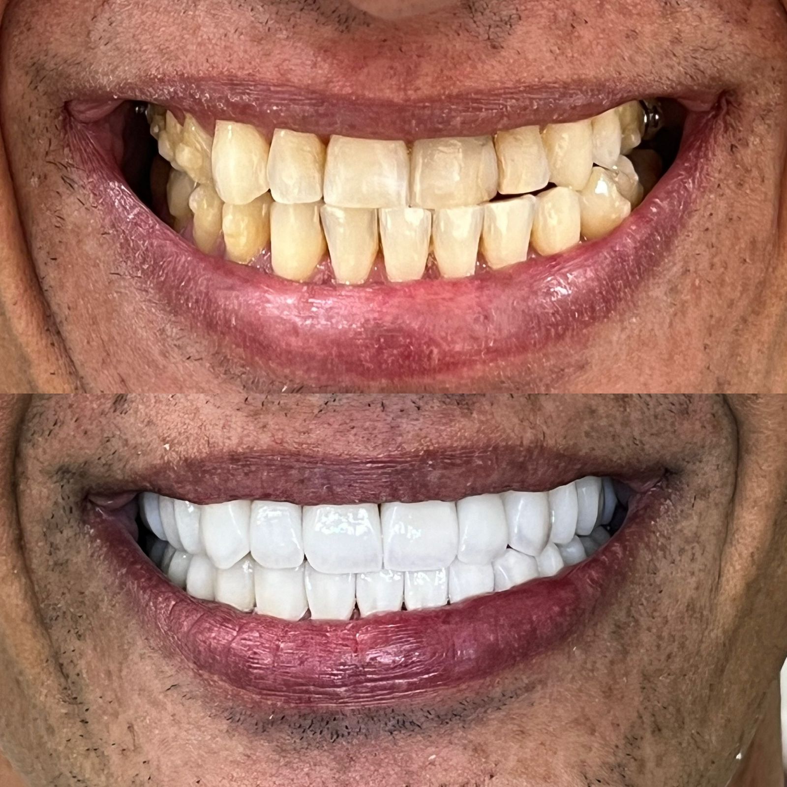 antes-depois-dr-fabio-moura-17