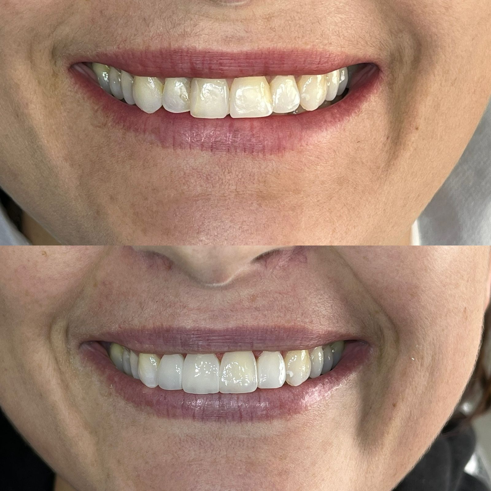antes-depois-dr-fabio-moura-6