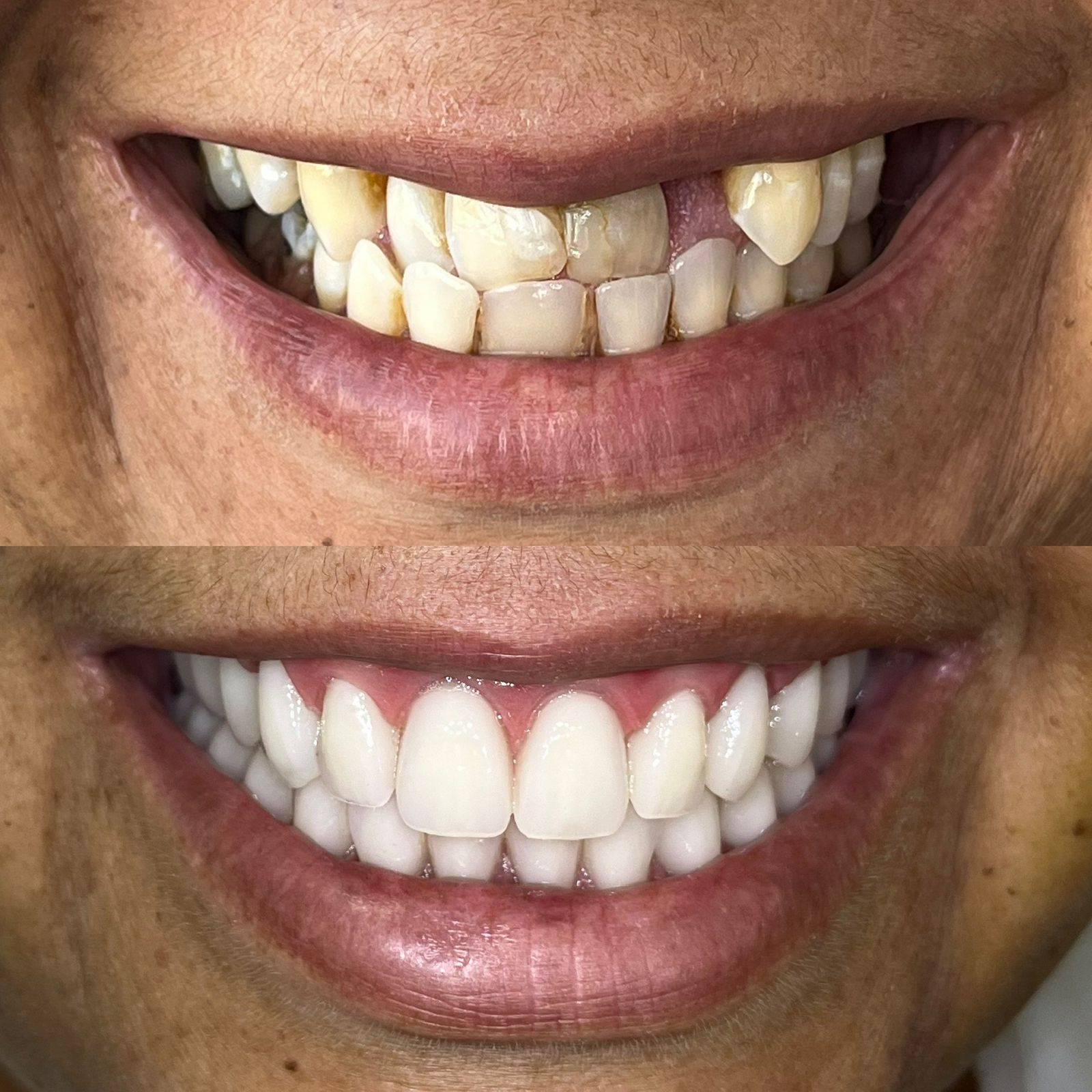 antes-depois-dr-fabio-moura-7